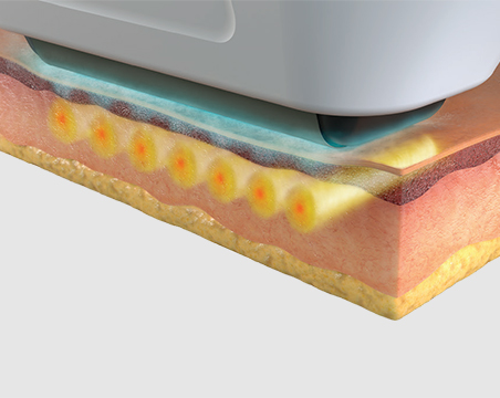 땡큐피부과 소프웨이브 POINT
