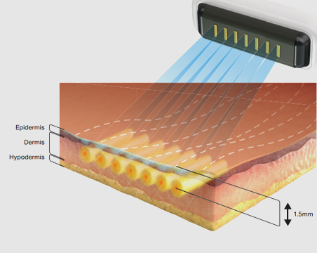 땡큐피부과 소프웨이브 POINT