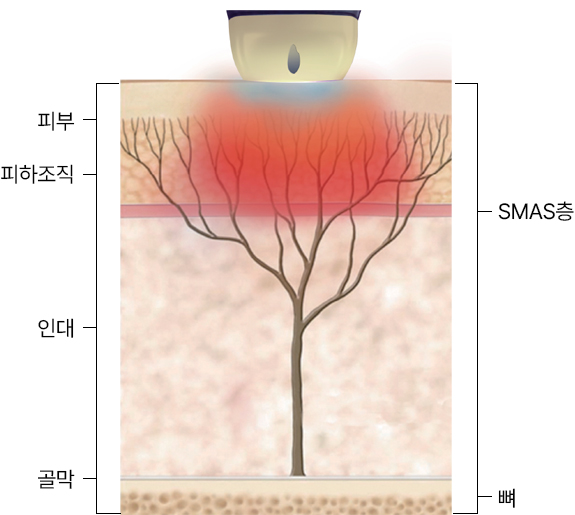 땡큐피부과 티타늄 리프팅
