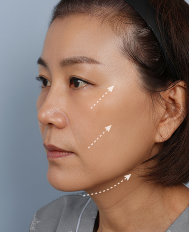 땡큐피부과 전후사진