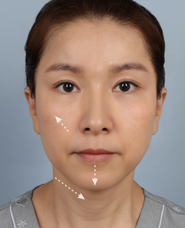 땡큐피부과 전후사진