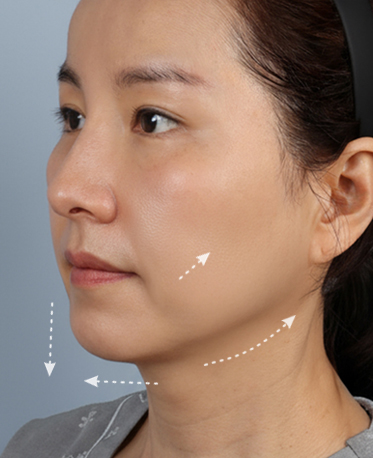 땡큐피부과 전후사진